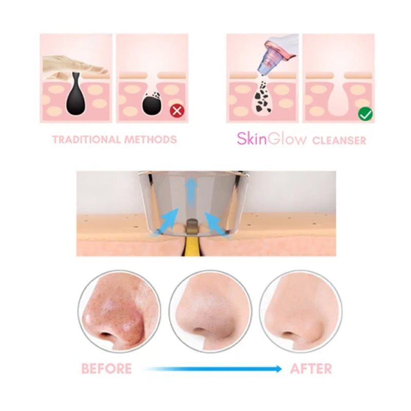 SkinGlow Electric Cleanser - No More Blackheads